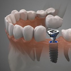 Illustration of dental implant between natural teeth