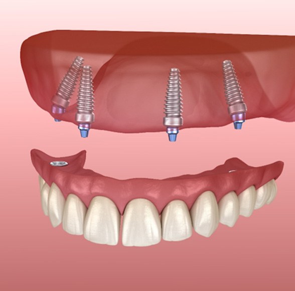 Render of All-on-4 in Williamstown, NJ for the upper jaw