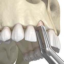diagram of a bone graft procedure for dental implants in Williamstown