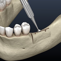 diagram of a ridge expansion for implants in Williamstown