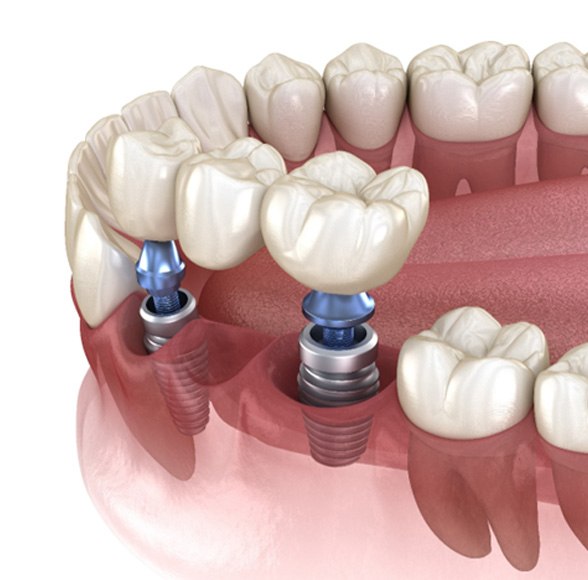 Diagram of an implant dental bridge in Williamstown