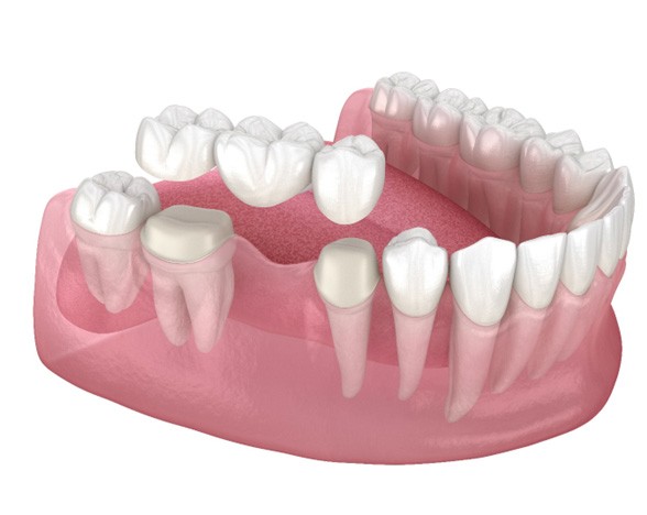 Illustration of lower arch with dental bridge in Williamstown, NJ