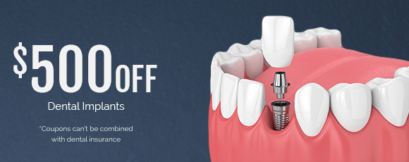 Dental implant special coupon