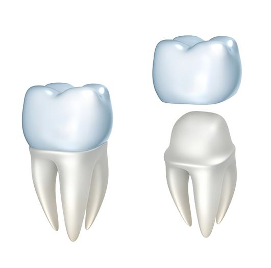 Model of a dental crown covering a tooth