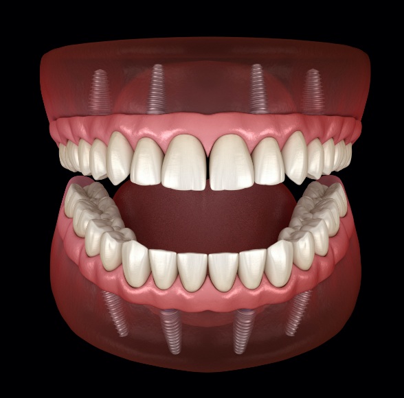 Animated smile with dental implant supported dentures