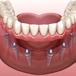 Digital illustration of implant dentures