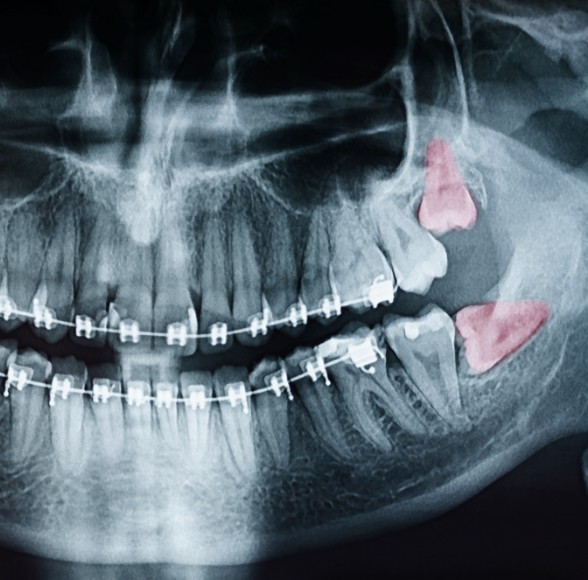 X-ray of impacted wisdom teeth prior to extraction