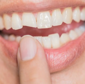 Smile with chipped front tooth