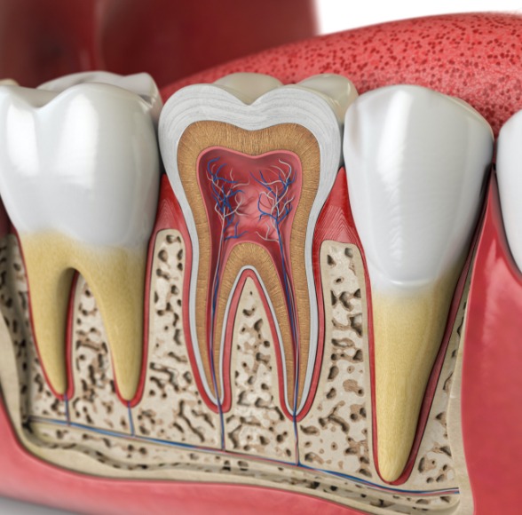 Animated inside of a tooth in need of root canal therapy