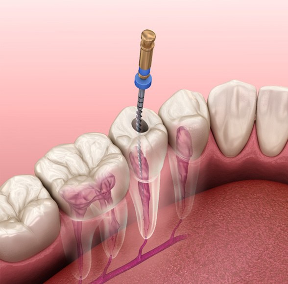 Illustration of root canal therapy for lower arch