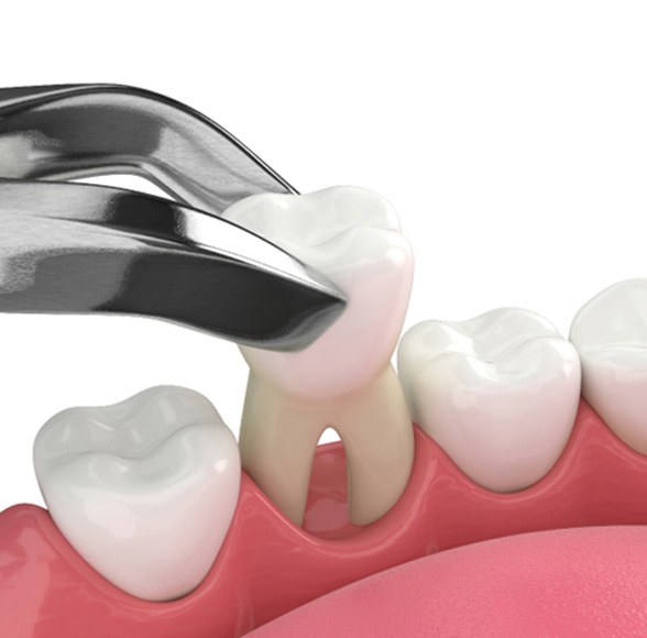 Illustration of tooth being extracted with forceps