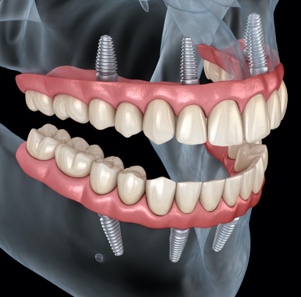 Animated smile during dental implant supported denture placment