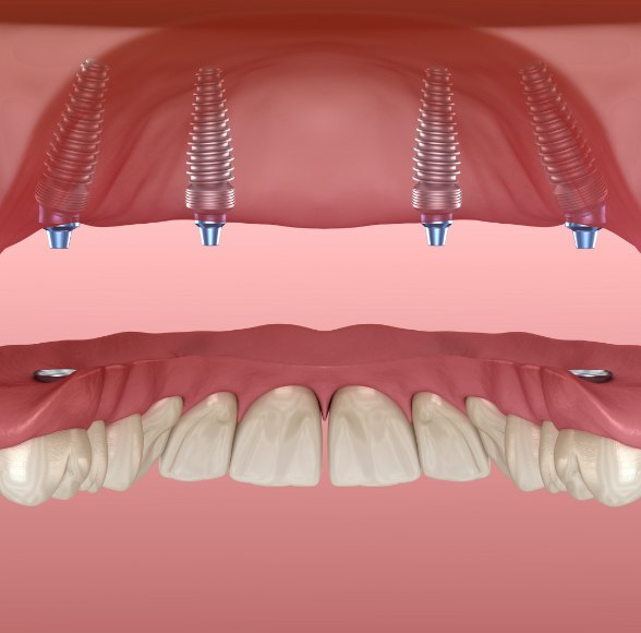 Animated smile before dental implant supported denture placement