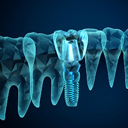 Illustration of a digital model of dental implants in Williamstown, NJ next to natural teeth