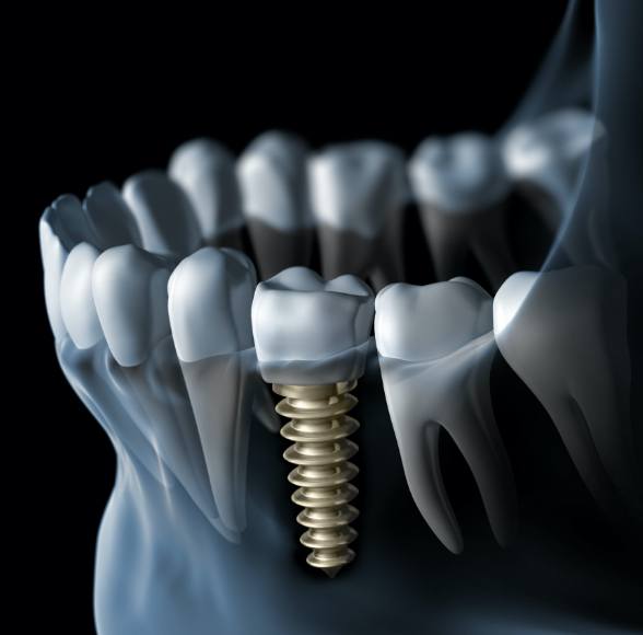 Animated smile with dental implant supported dental crown