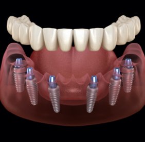 Animated smile during dental implant supported denture placement