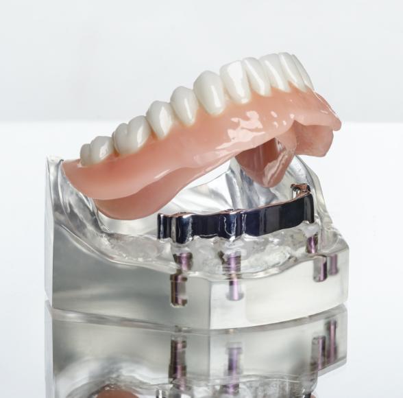 Model smile with dental implant supported denture