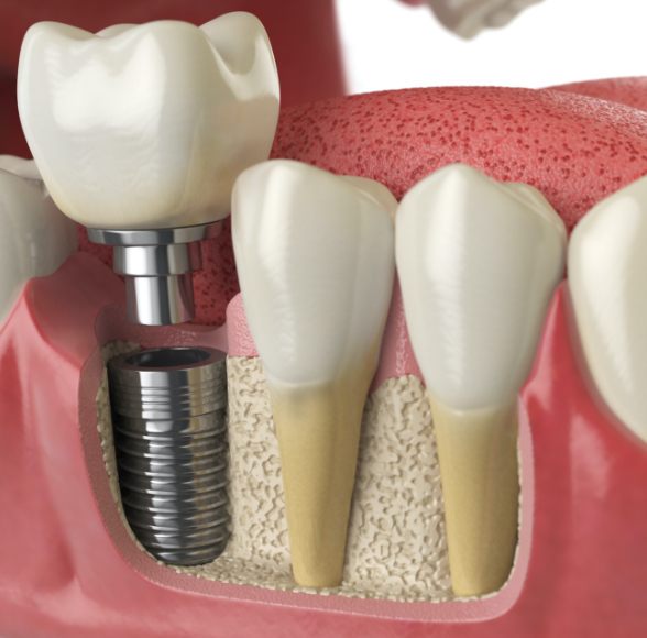 Animated smile during dental implant replacement tooth placement