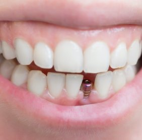 Dental implant post visible in smile after dental implant surgery