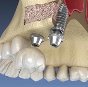 Animated smile during abutment placement after osseointegration