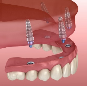 Animated smile during dental implant restoration placement