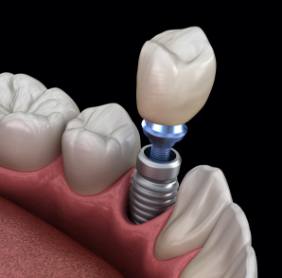 Aniamted smile during dental implant supported dental crown placement