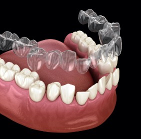 Animated smile with Invisalign tray
