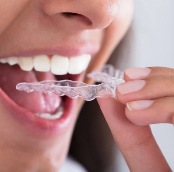 Closeup of patient placing Invisalign tray