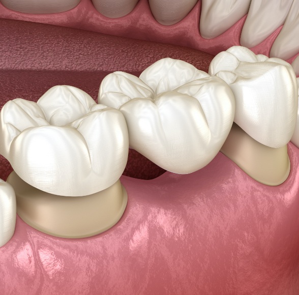 Animated smile during dental bridge placement