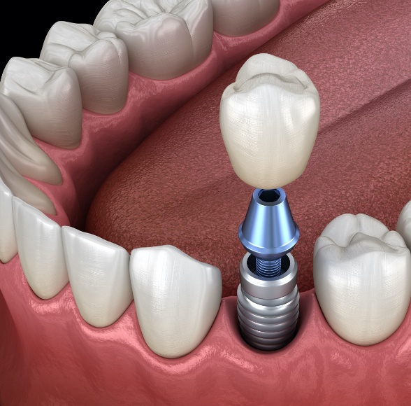 Animated smile during dental implant supported dental crown placement