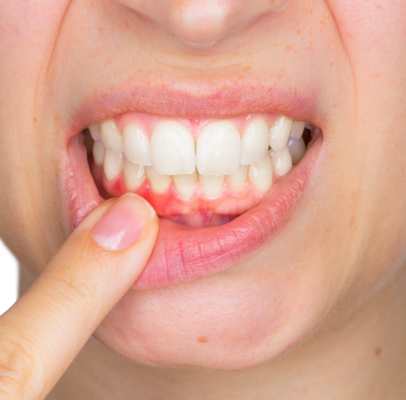 Closeup of damaged gum tissue that may be a sign of oral cancer