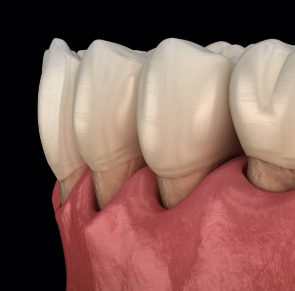 Closeup of smile with receding gums before periodontal therapy