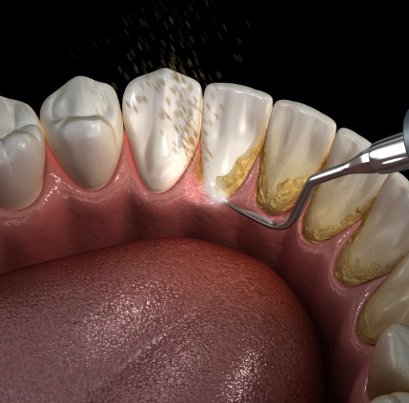 Animated smile during scaling and root planing treatment