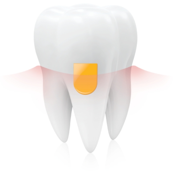 Aniamted tooth with periochip therapy device