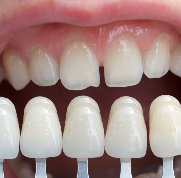 Smile compared with porcelain veneer samples