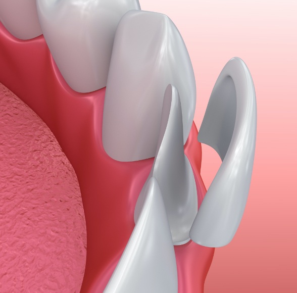 Animated smile during porcelain veneer placement