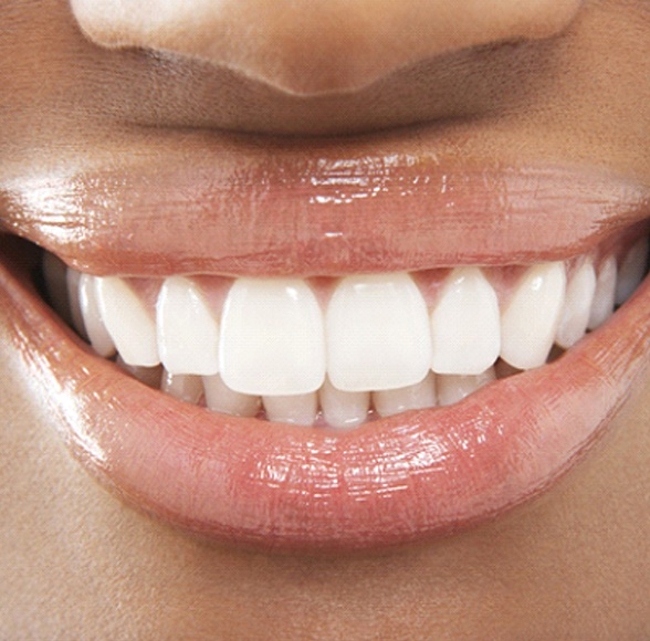 Close-up of woman’s beautiful smile with veneers in Williamstown