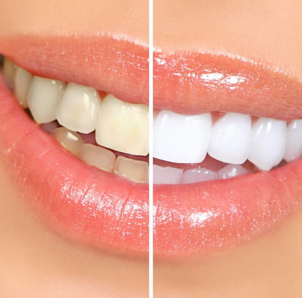 Smile before and after teeth whitening