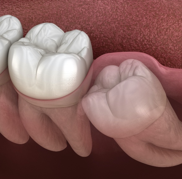 Animated smile with impacted wisdom tooth prior to extraction