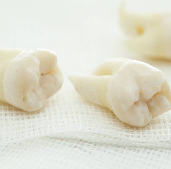 Extracted wisdom teeth on tray