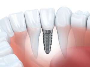 dental implants in williamstown