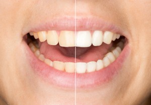 teeth whitening in Williamstown