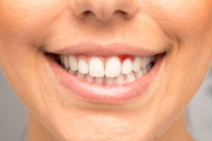 Woman with bright red gums smiling