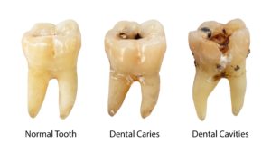 Image of decayed teeth at cosmetic dentist in Williamstown