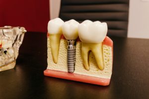 Model used during dental implant consultation