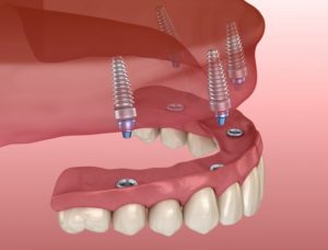 3D illustration of all-on-4 dental implants 