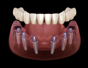 3D illustration implant dentures
