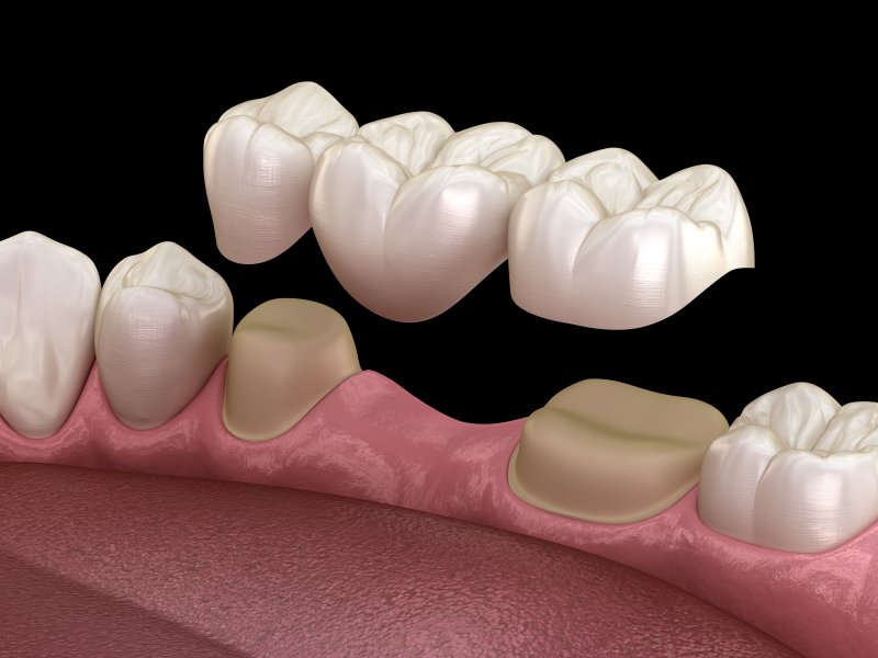 Dental bridge being placed on prepared teeth