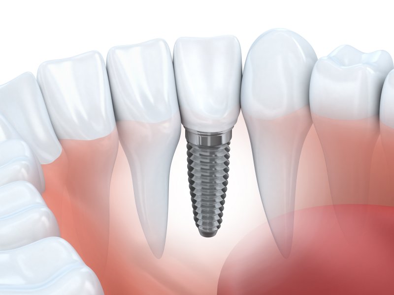 example of dental implants after tooth extraction in Williamstown