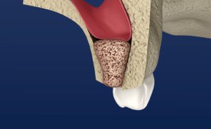 Digital model of a bone graft